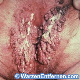 pictures of anal herpes #11