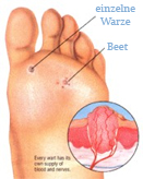 Warzen am Fuß